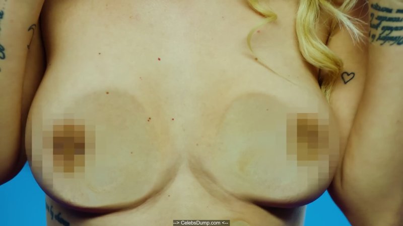 Pic: Mammoplasty before and after