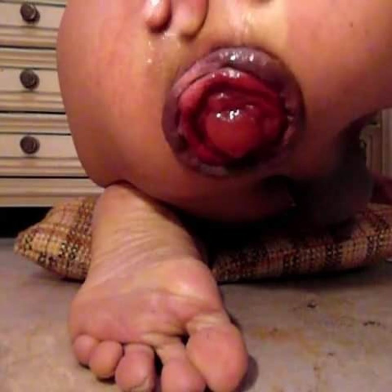 ANAL PROLAPSE