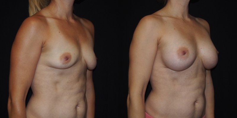 Pic: Breast enlargement