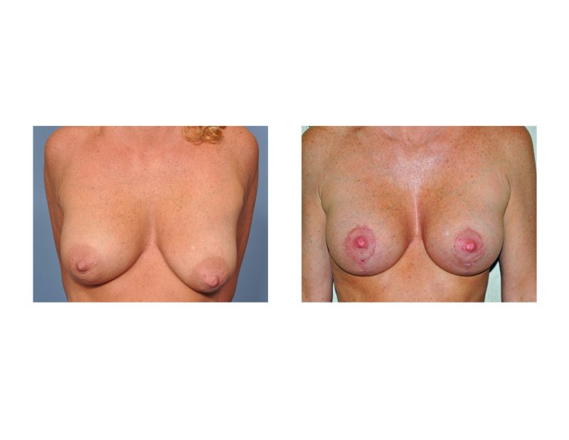 Pic: Breast enlargement