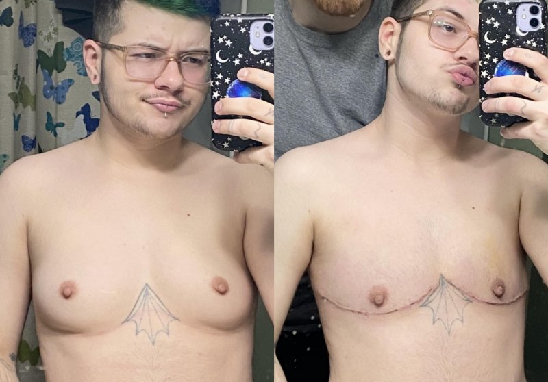 The chest of the transgender